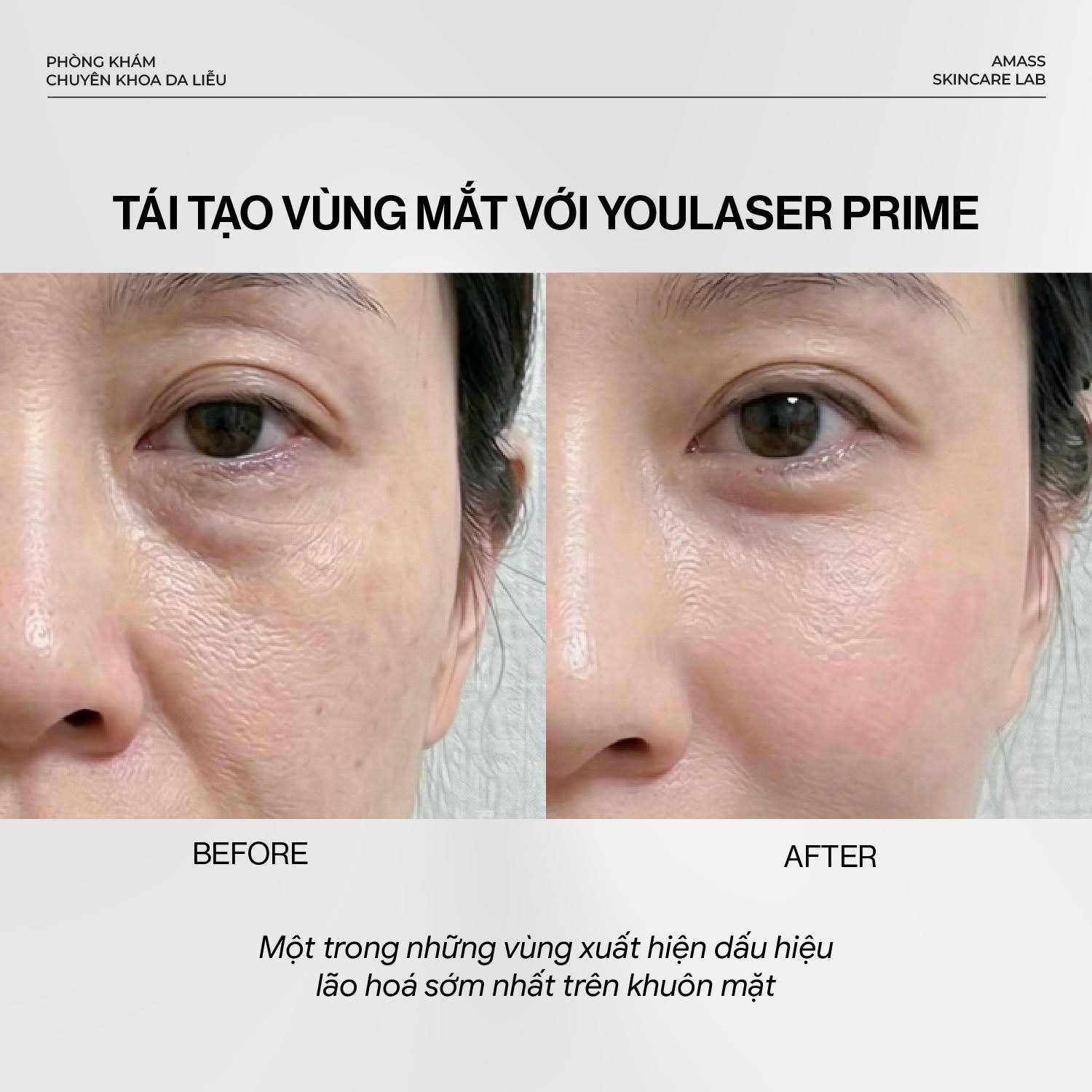 tai-tao-tre-hoa-vung-mat-bang-cong-nghe-youlaser-prime